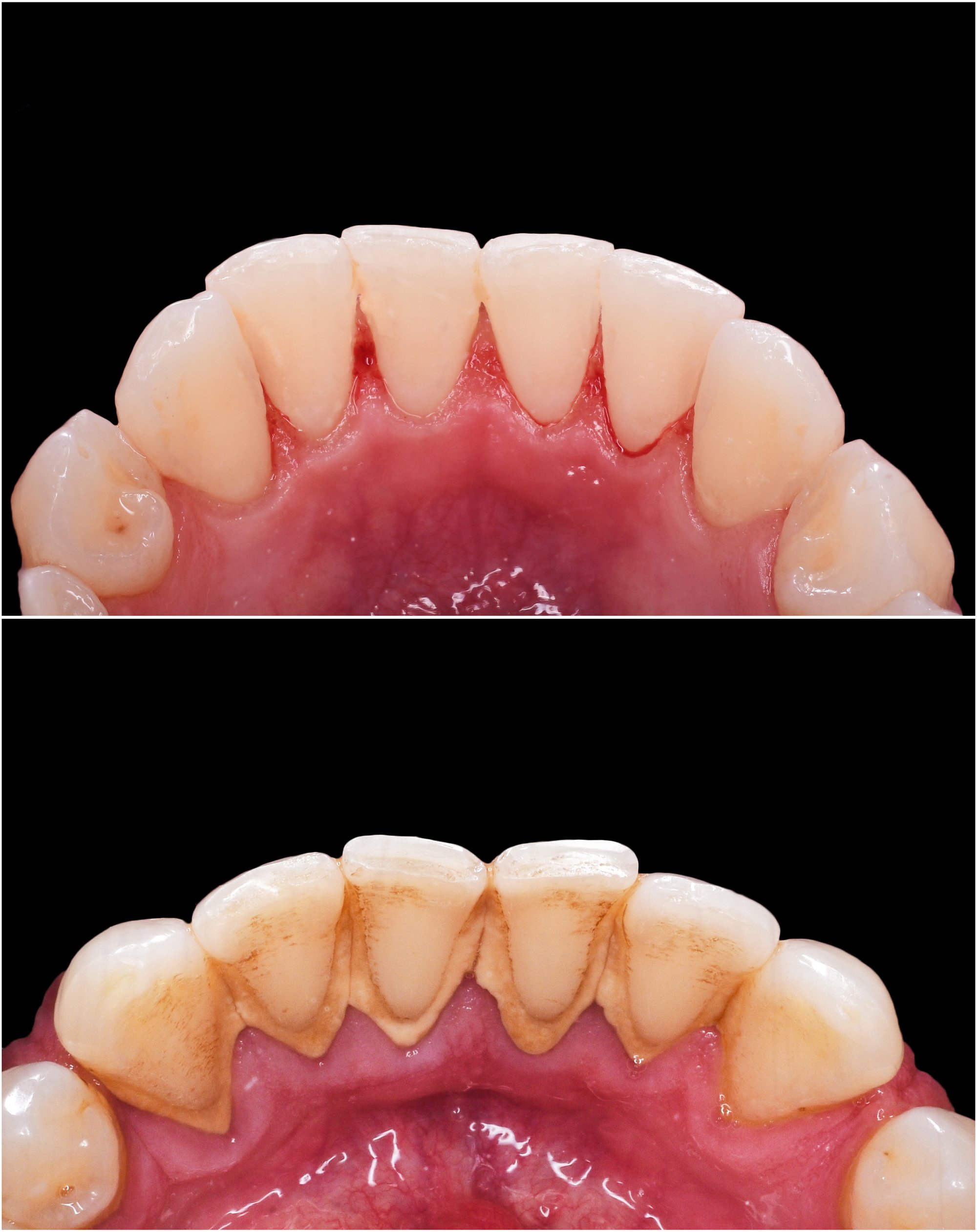 How Often Should I Actually Schedule a Dental Cleaning?